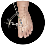 Minimally Invasive Fracture Repair