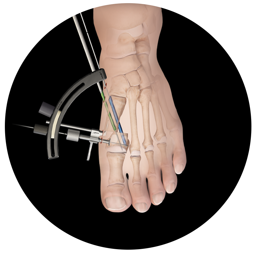 Minimally Invasive Fracture Repair